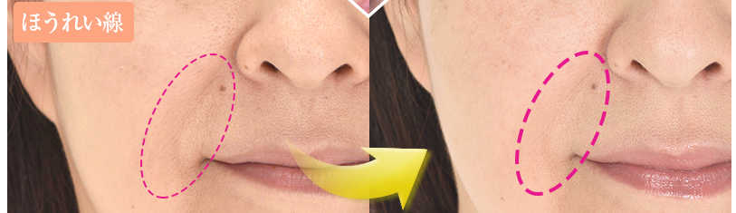 シワ,速攻.伸ばし,化粧品