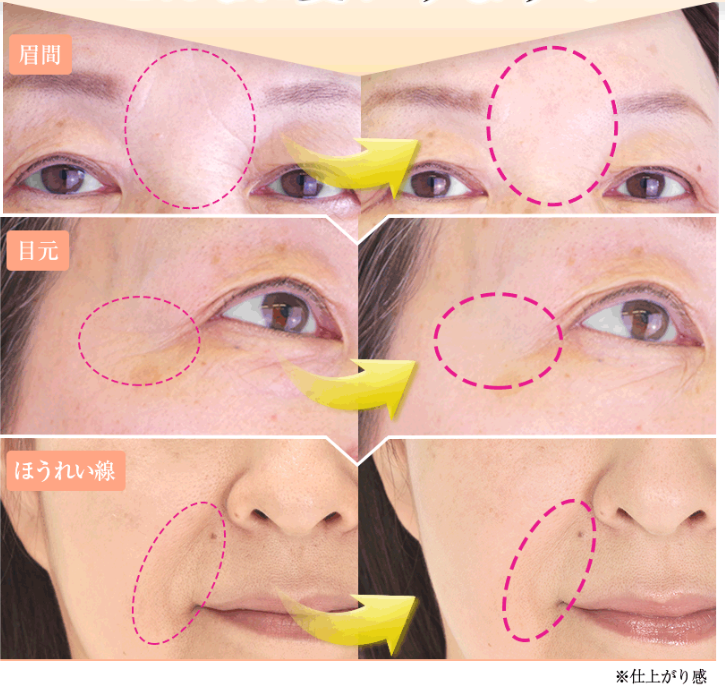 シワ,速攻.伸ばし,化粧品